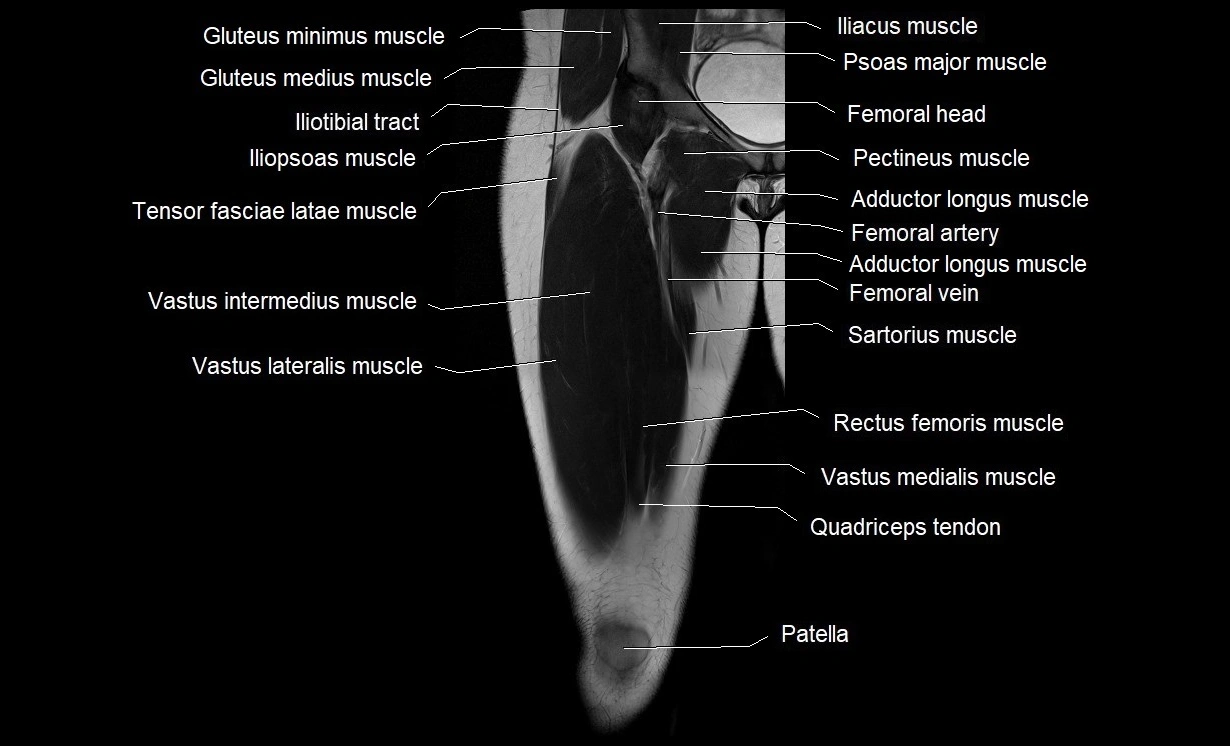 MRI thigh coronal cross sectional anatomy image 7.webp